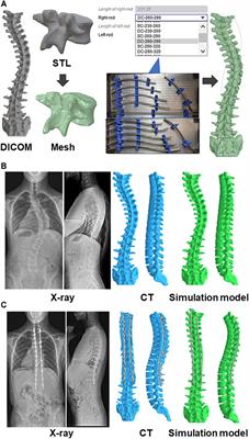 Surgical Outcome Prediction Using a Four-Dimensional Planning Simulation System With Finite Element Analysis Incorporating Pre-bent Rods in Adolescent Idiopathic Scoliosis: Simulation for Spatiotemporal Anatomical Correction Technique